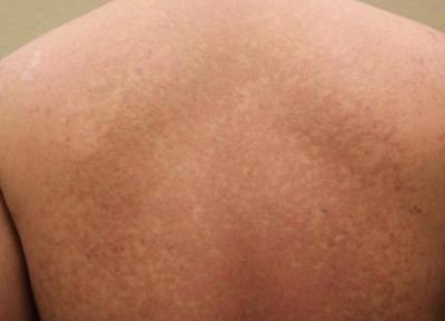 بیماری پوستی تینه آ ورسیکالر چیست؟
